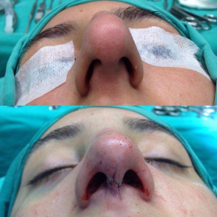 nose plastic surgery